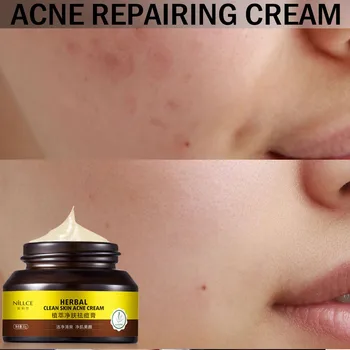 

Acne Treatment Cream for Face Pimple Acne Scar Blackheads Removal Cream unclog pores Greaseless odorless Treatment Face Creams