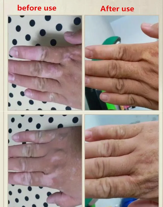 

Vitiligo care for external use, melanin-repairing solution, white spot net cream, white spot repairing liquid