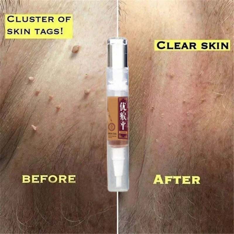 Skin Tag Remover  Against Mole & Genital Wart fast RemovWithin al Anti Foot Corn Removal Warts Papillomas Rapidly removes moles