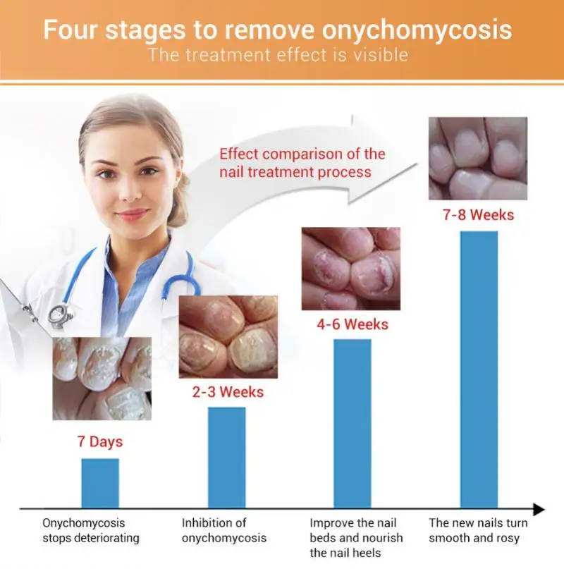 12 мл средство для восстановления ногтей, жидкое средство для лечения грибков ногтей, против онихомикоза, грибок для пальцев ног, питательное средство для осветления ногтей TSLM2
