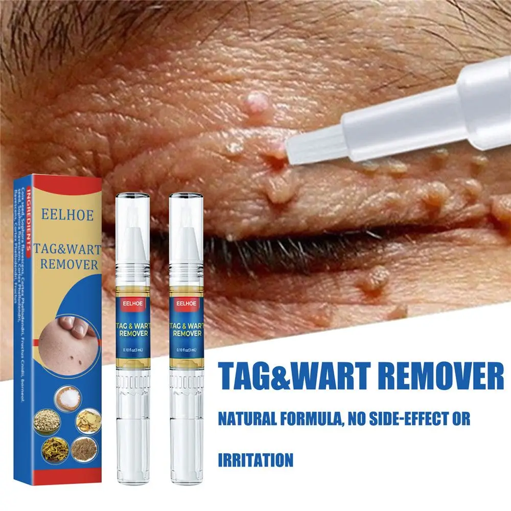3ml Removing Against Moles Genital Wart Treatment Papillomas Removal Of 