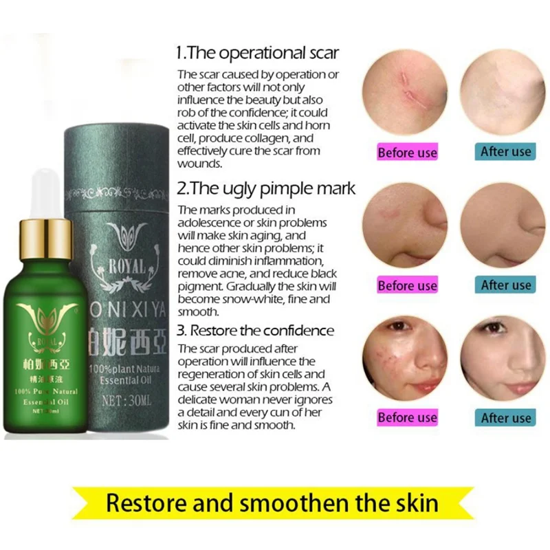 Face Care Essential Oil Acne Scar Spots Removal Skin Care Whitening Remove Scars Acne Repair Face 1 Face Care Essential Oil Acne Scar Spots Removal Skin Care Whitening Remove Scars Acne Repair Face 5