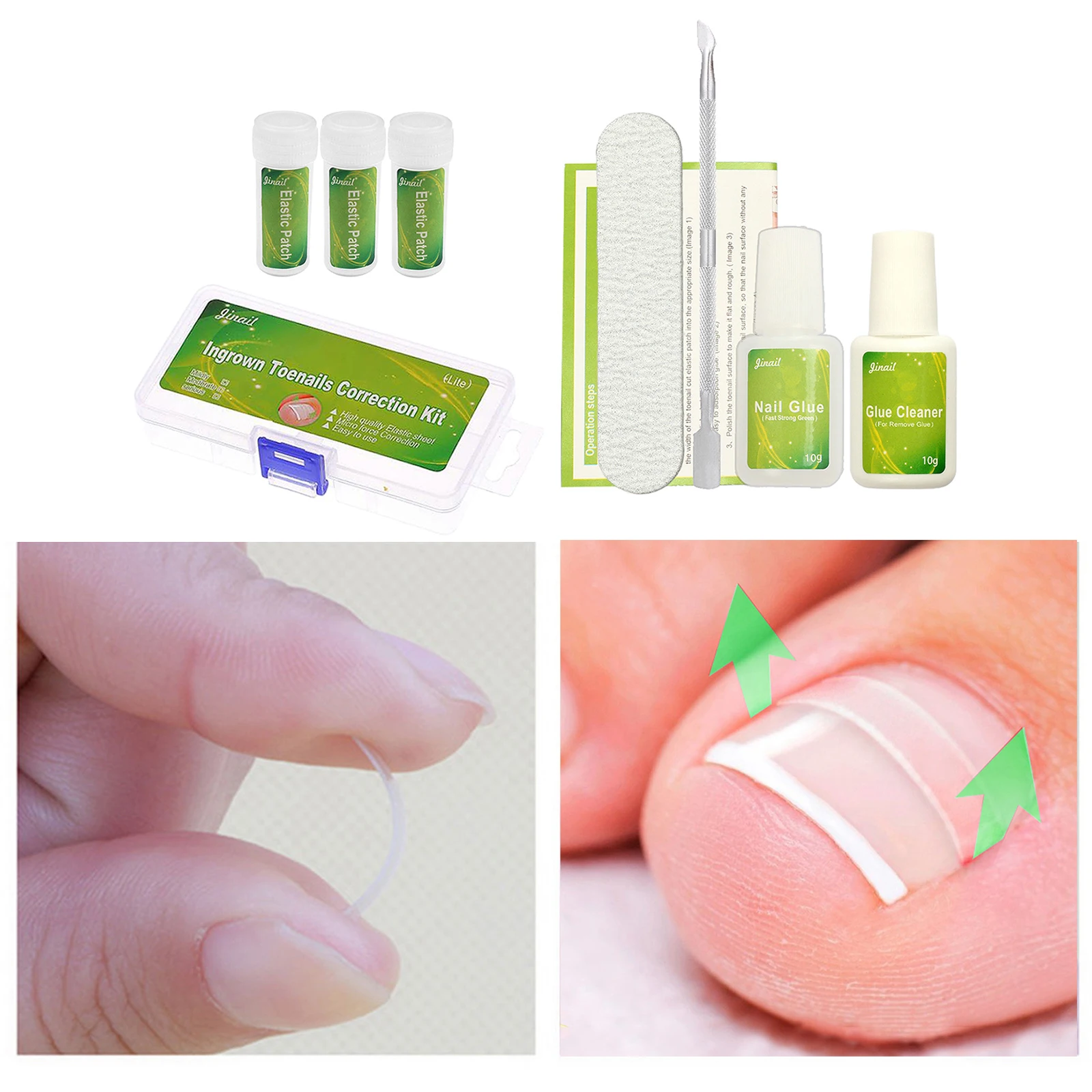 Ingrown Toenail Correction Tool Toenail Treatment Corrector Stickers W/ Glue