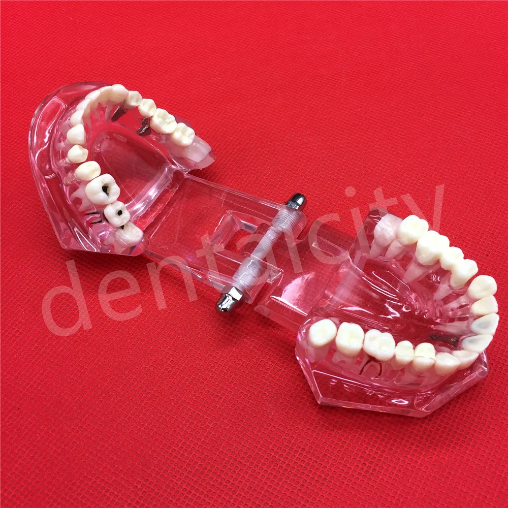 Новая модель зубного импланта с реставрационным мостом для протеза|teeth model|dental
