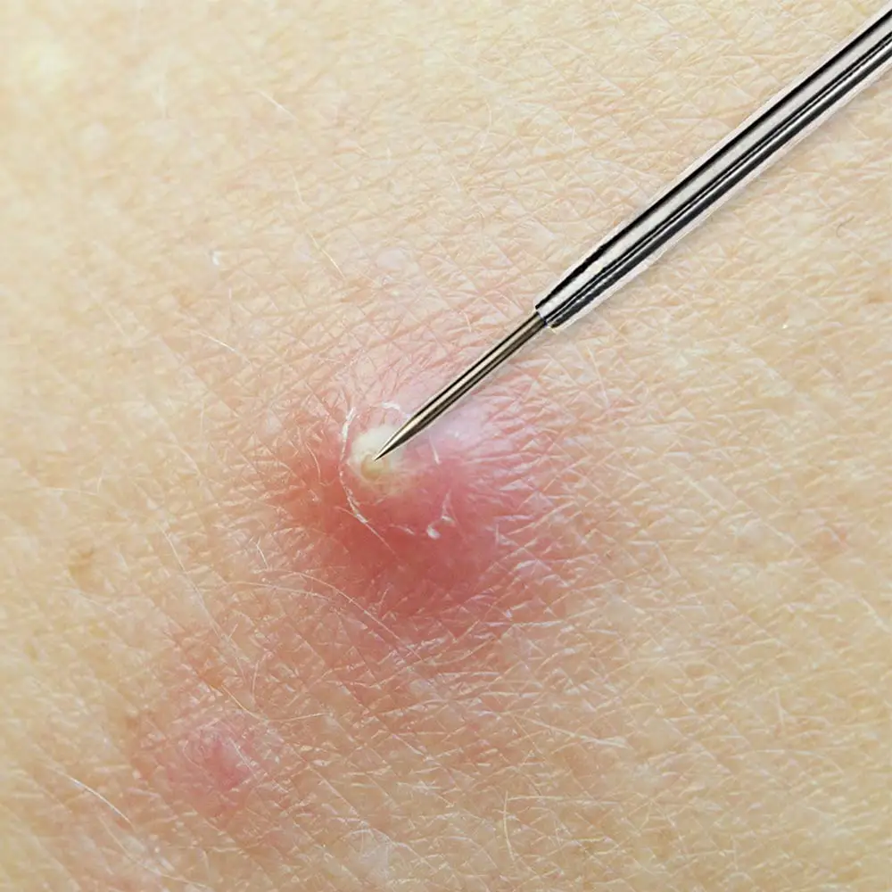 Blackhead Removal Needles 1