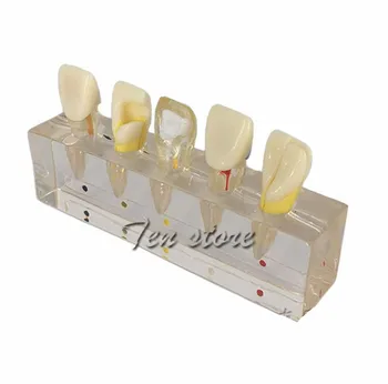 

Caring-Pulp Dental Clinical Model Oral Disease Model Tooth Teeth Model