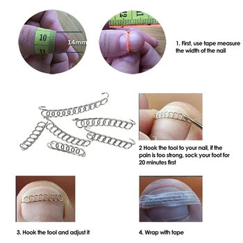 

3pcs/set Pedicure Acronyx Wire Nail Ingrown Correction Wire Patch Foot Care Paronychia Correction File Spring Ingrown Toe Tools