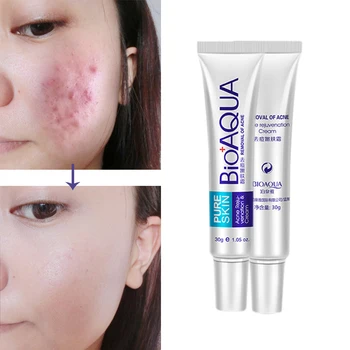 

Bioaqua 30g face anti care acne treatment cream scar removal oily skin Acne Spots skin care face stretch marks