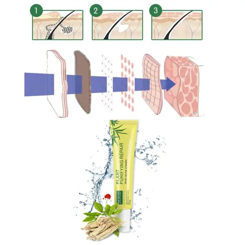 20 г крем для удаления шрамов от акне, уход за кожей лица, пятна, пятна, лечение, уход за лицом; отбеливание