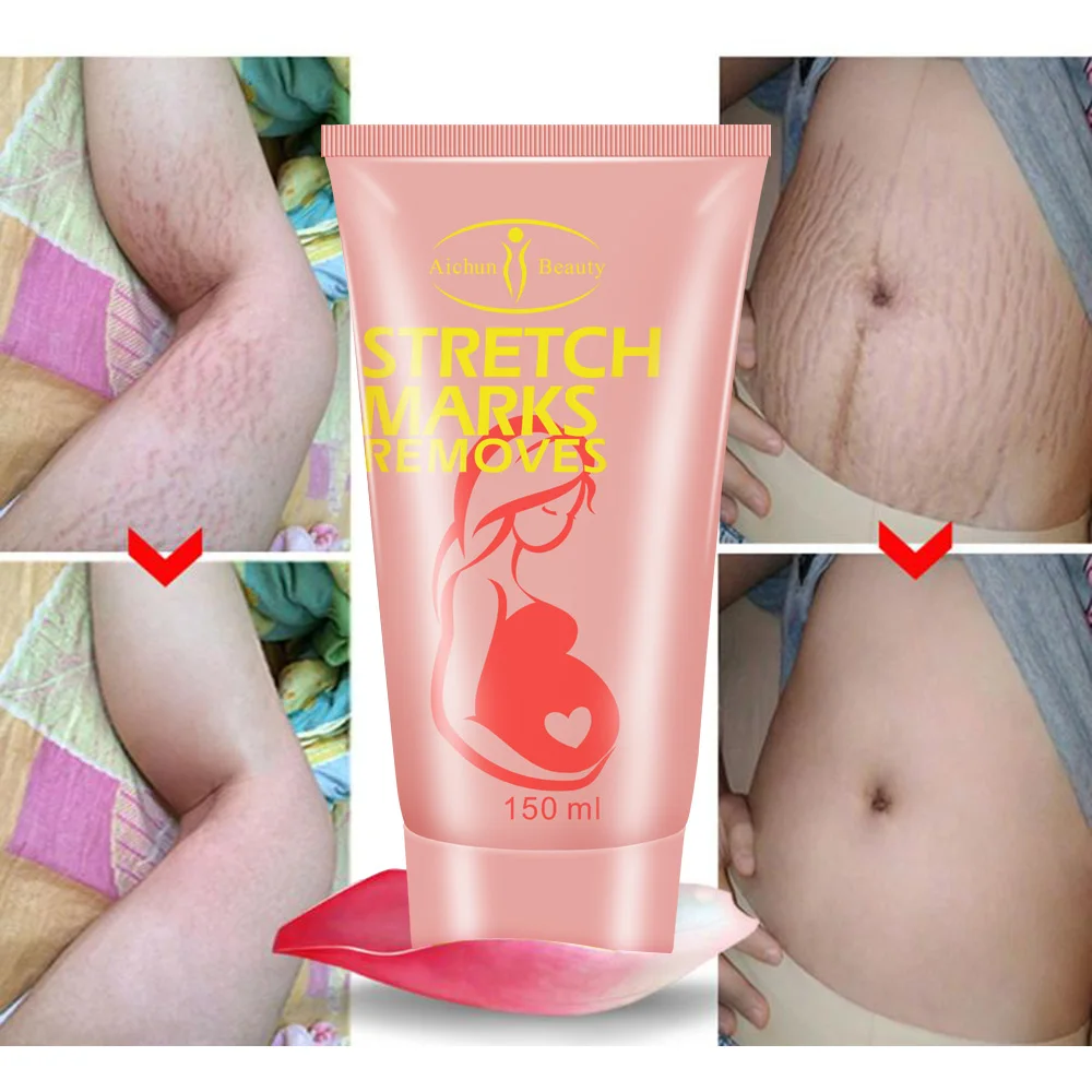 aichun stretch mark cream
