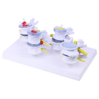 

1 Set Human Lumbar Lesion Spine Statue Display Model Medical Teaching Learning Tool