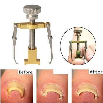 

Ingrown Toe Nail Fixer Pedicure Recover Embed Toenail Correction Lifter Tool Set Onyxis Bunion Onychia Corrector