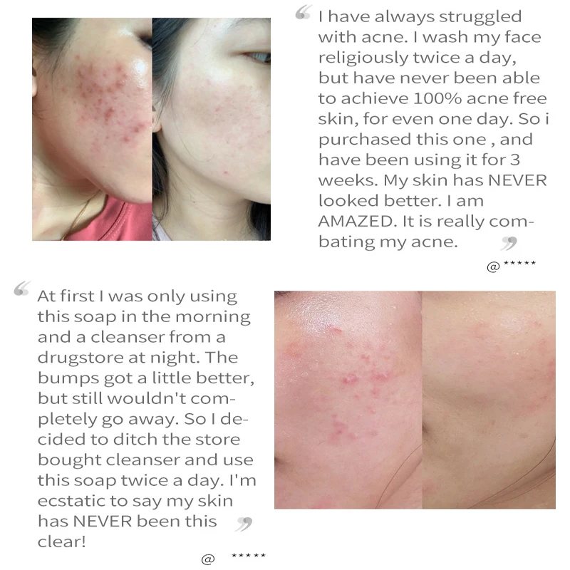 Anti-acne Turmeric Soap Cleans Skin Remove Mites Shrink Pores For Bath Handmade Natural Skin Whitening Soap Anti-inflammatory