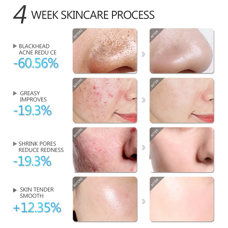 Blackhead Remover Salicylic Acid Face Mask Facial Cleansing Against Black Dots Acne White Clay Mask Cream Skincare Cosmetics 2 Blackhead Remover Salicylic Acid Face Mask Facial Cleansing Against Black Dots Acne White Clay Mask Cream Skincare Cosmetics 2