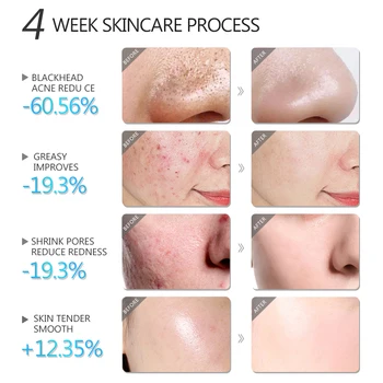 Blackhead Remover Salicylic Acid Face Mask Facial Cleansing Against Black Dots Acne White Clay Mask Cream Skincare Cosmetics 2