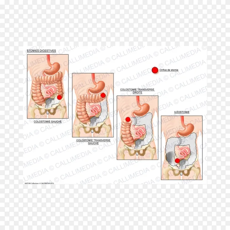 回肠造口 口消化性结肠造口术 内分泌系统png图片素材免费下载 图片编号4405533 Png素材网