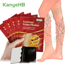 

12pcs/2bags Chinese Varicose Veins Patch Vasculitis Phlebitis Leg Medical Plaster Treatment Varicosity Angiitis Stickers A593