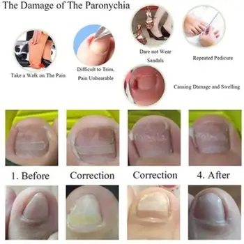 

Toenail Ingrown Correction Tool Toe Nail Lifter Nail Products Straightening Patch Toenail Recover Foot Pedicure Care Pusher B3J5