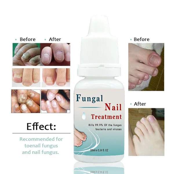 LANTHOME грибковое жидкое Лечение ногтей Отбеливание ногтей и ног удаление грибка для ног Уход за ногами эссенция жидкость для восстановления ногтей