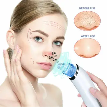 

Whitehead Blackhead Removal Device Pore Cleaner Vacuum Blackhead Remover Vacuum Facial Rechargeable Suction Instrument Tool Kit