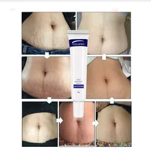 Гладкий крем для кожи, крем для удаления шрамов, жировых морщин, для беременных, для восстановления кожи, крем для тела, мягкие растяжки для кожи