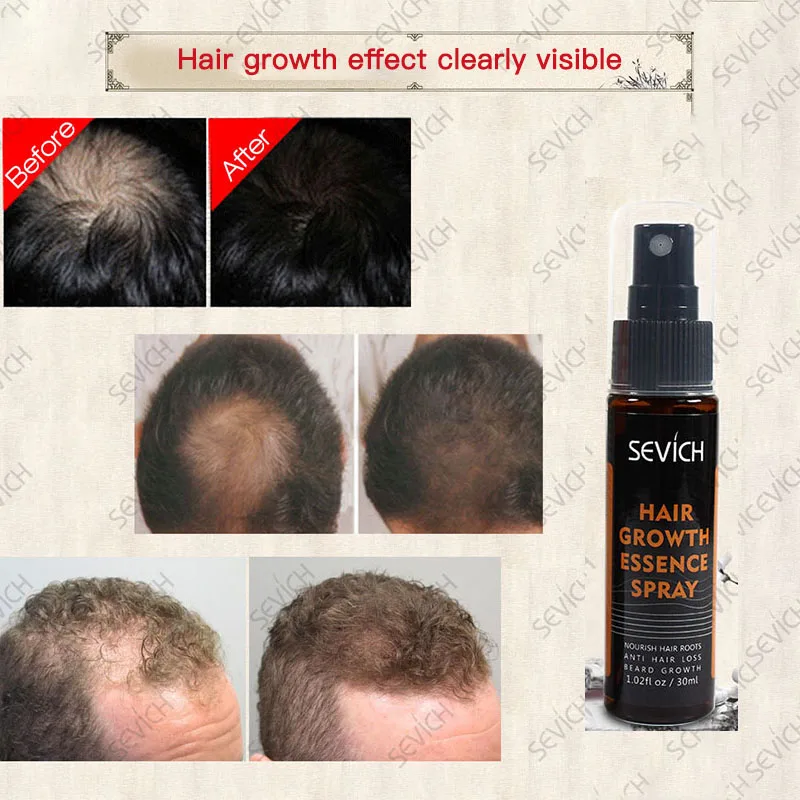 Spray para el crecimiento del cabello, líquido para la pérdida de cabello dañado, tratamiento para la pérdida de cabello al por mayor, 30ml