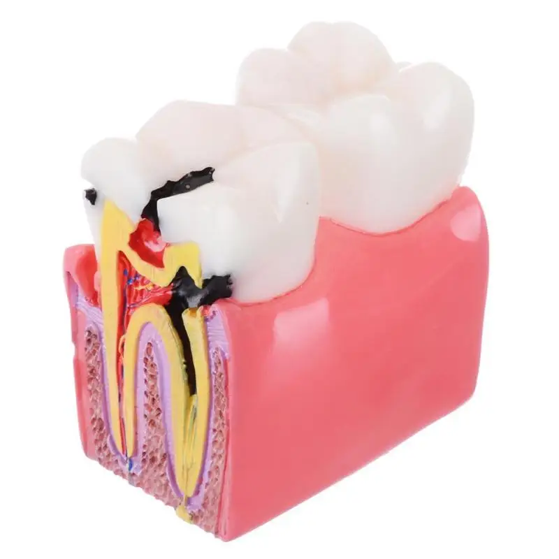 

6 Times Caries Teeth Model Dental Anatomy Implant Disease Education Dentist Medical Science Study Tool