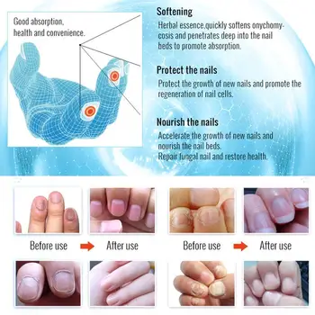 

10ml OMY LADY Fungal Nail Treatment Essence Foot Nail Paronychia Infection Serum Repair Anti Fungus Onychomycosis I9Z9