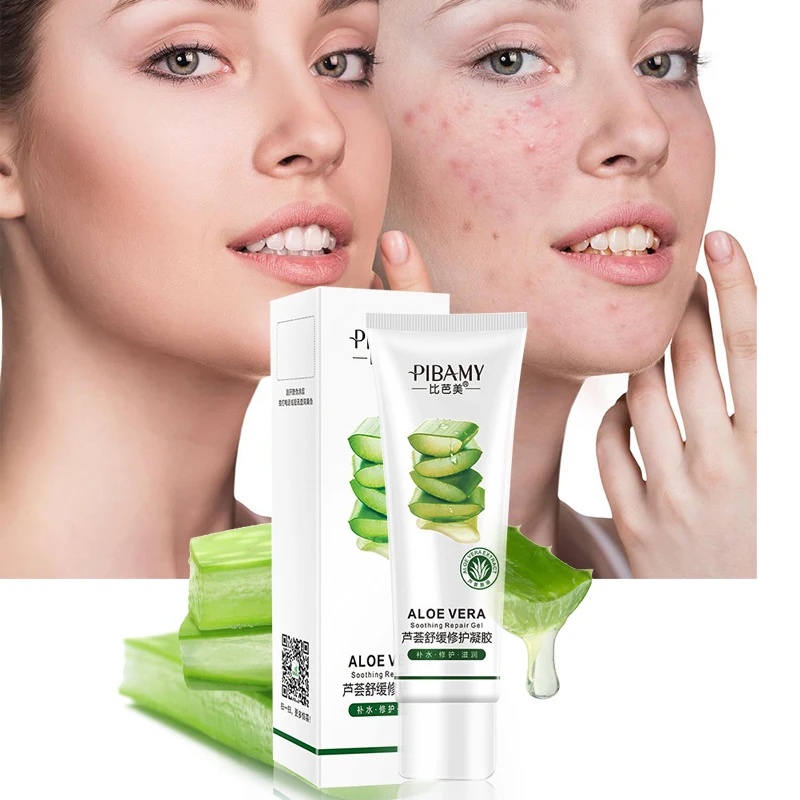aloe vera cream for acne