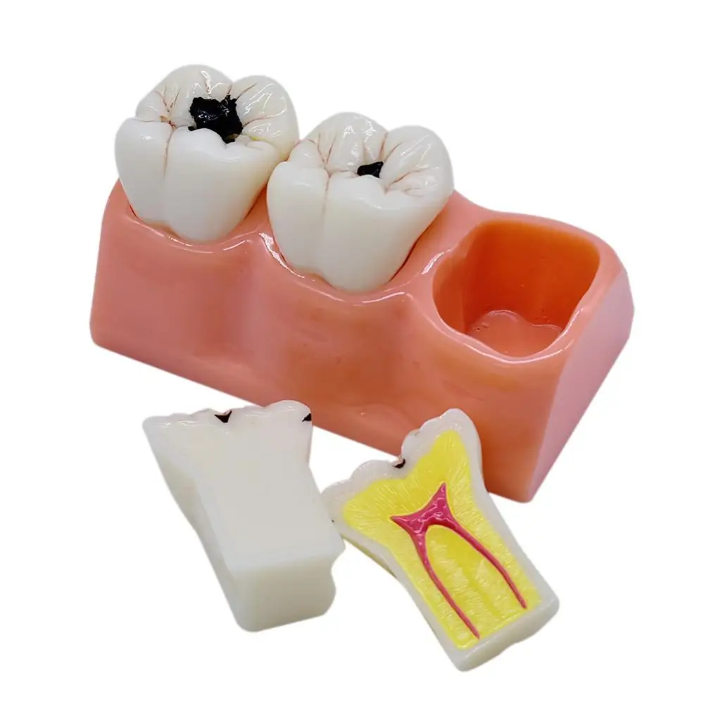  Dental teaching Model patien communication Dissected Caries Model Caries Decomposition Model Oral D - 4000402181013