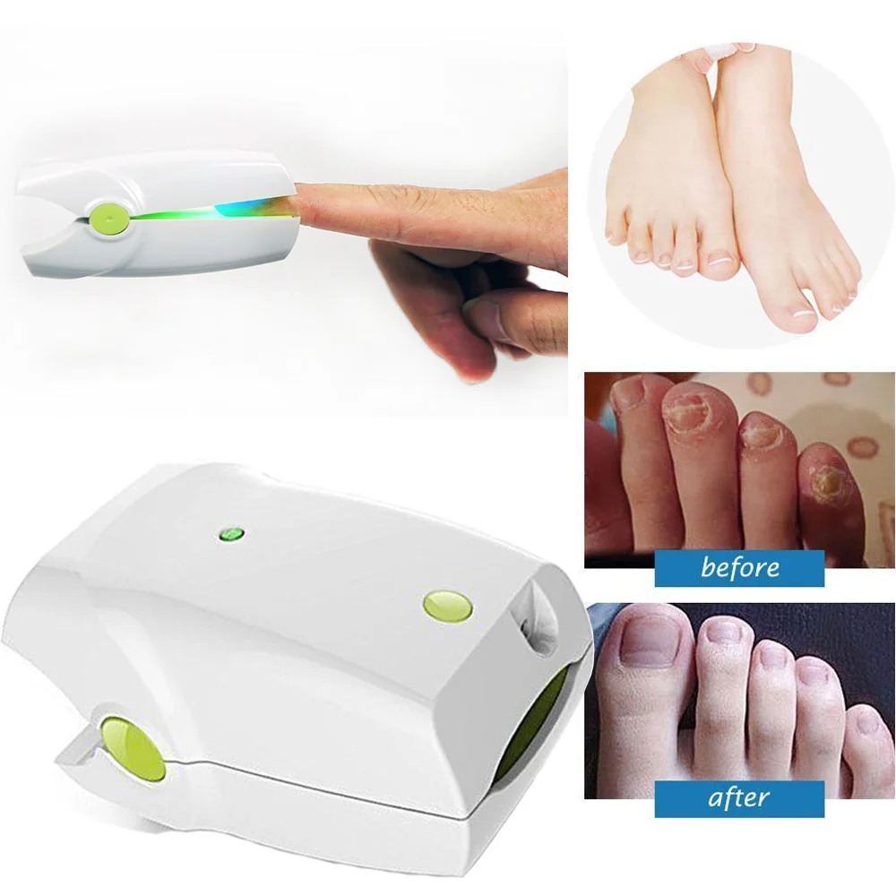 New Home Use Toenail Fungus Removal Nail Fungal Cleaning Light Therapy