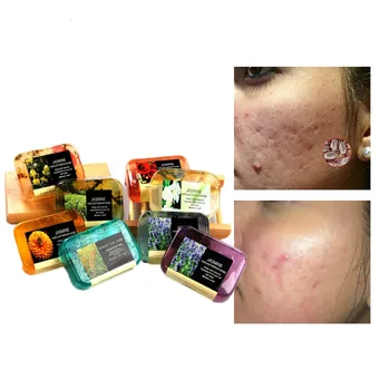 

Cleaner acne whitening cleansing soap professional cutin acne removal mite bath soap men and women can be used all over the body