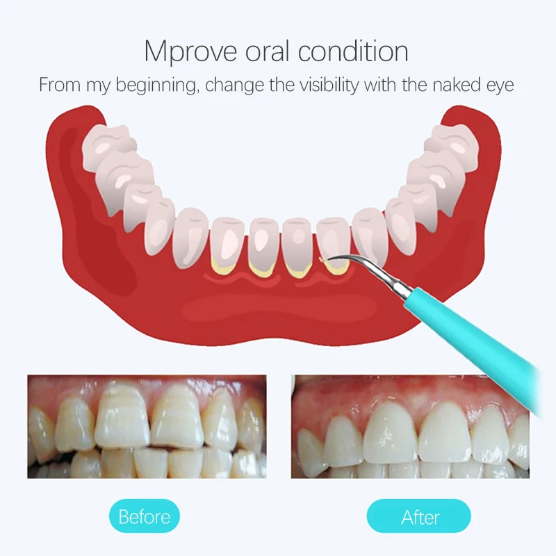 Goedkoop Oplaadbare tanden bleken ultrasone reiniging apparaat Tanden whitening Waterdichte elektrische tooth cleaner calculus remover