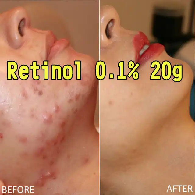 Original Retinol A Face Gel Cream 0 1 g Acne Scar Removal Cream Anti Wrinkles Blemish Treatment Free Ship Aliexpress