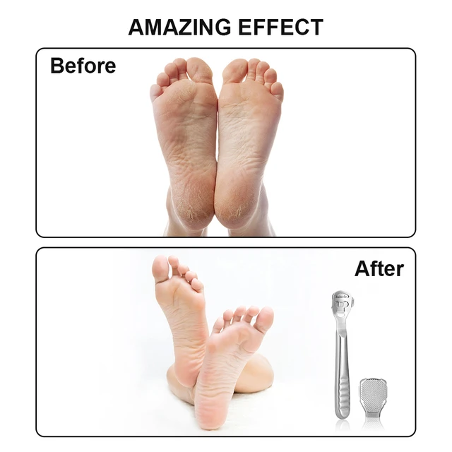 Callus Shaver Sets Include 10 Replacement Callus Shavers Foot Care