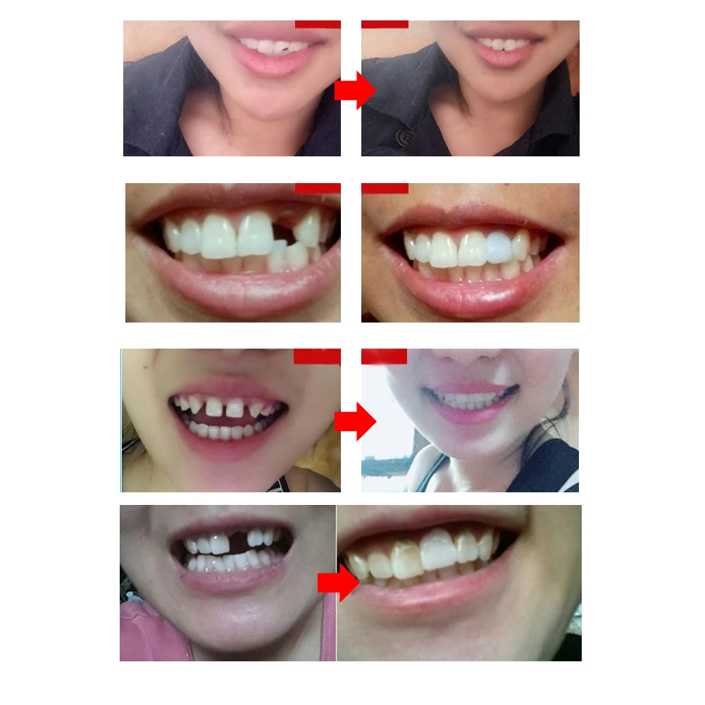 Временный набор для ремонта зубов. Фотокомпозитные виниры. Починка съемного протеза. Можно ли починить зуб. Зубные протезы съемные.