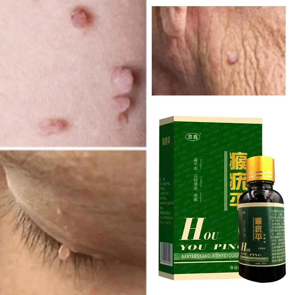 

Genital Warts Removal Antibacterial Liquid Foot Calluses Skin Care Relief Wart Cream Flat Meat Corn Medical Treatment Skin Y5T5
