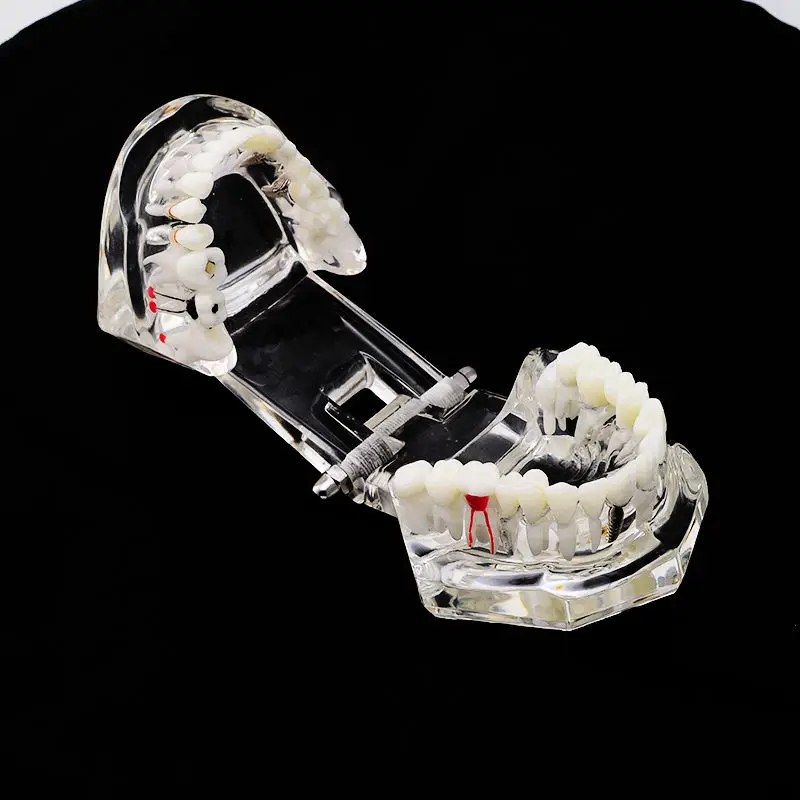 Стоматологическая демонстративная модель зубов имплантата с восстановлением +