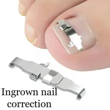 

2Pcs Ingrown Toe Nail Correction Tool Toenail Straightening Tool Patch Orthosis Tool Foot Repair Kit Correctors Care Nail U5L7