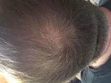 El crecimiento del cabello aceites esenciales cuidado del cabello esencia Original auténtico 100% pérdida de cabello líquido salud belleza suero denso para el crecimiento del cabello