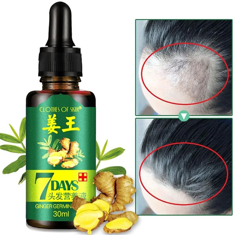 Aceite de jengibre Germinal para el cabello, solución nutriente para el crecimiento del cabello, esencia líquida rápida para la pérdida de cabello Natural, tratamiento para el cuidado del cabello