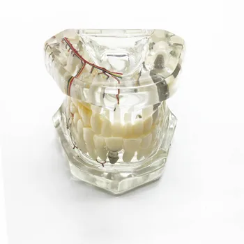 

Dental teeth model implant with nerve Transparent pathological Repair model Teaching demonstration model