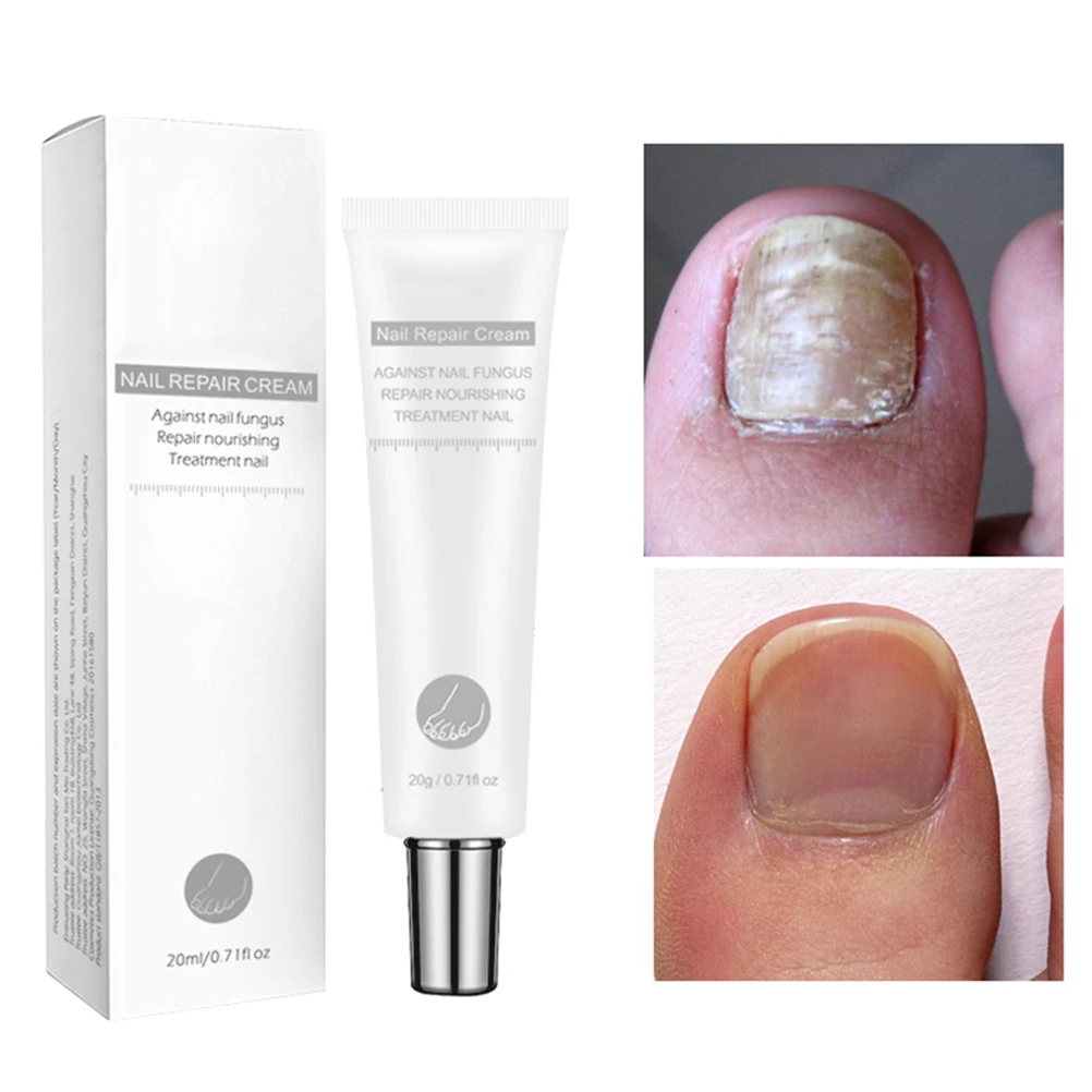 Nail Fungal Treatment Infection Repair Cream Anti Fungus Onychomycosis Removal Toe Finger | Красота и здоровье