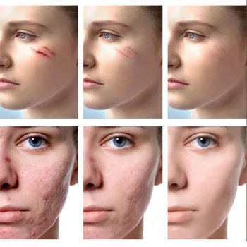 

Facial Care Repair Scar Cream Removal Scars For Face & Body Pigmentation Corrector Scalded Surgery Scar Restore Day Cream