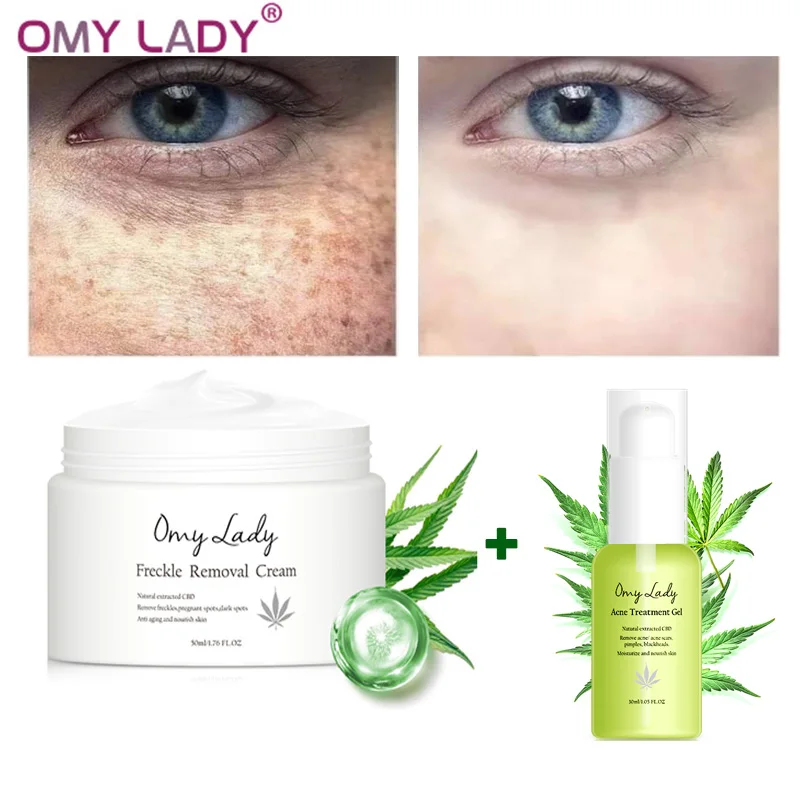 2 шт OMY LADY Acne Treatment Сыворотка для лица + удаление веснушек крем удаления пятен