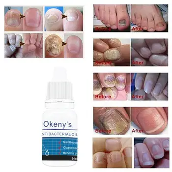 

Fungal Nail Treatment Nail Foot Whitening Toe Nail Nail Removal Care Repair Feet Fungus Gel For Onychomycosis Liquid N0Y8