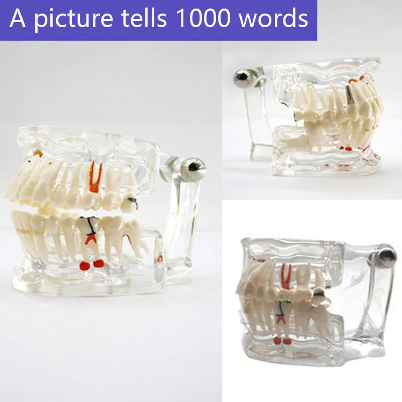 

Teeth Tooth Transparent Adult Pathological Model for Dental Study Adult pathological tooth model 2003