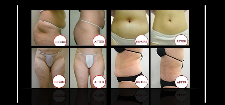 High quality cryotherapy slim freezer weight loss device/cryolipolysis cavitation rf slimming products