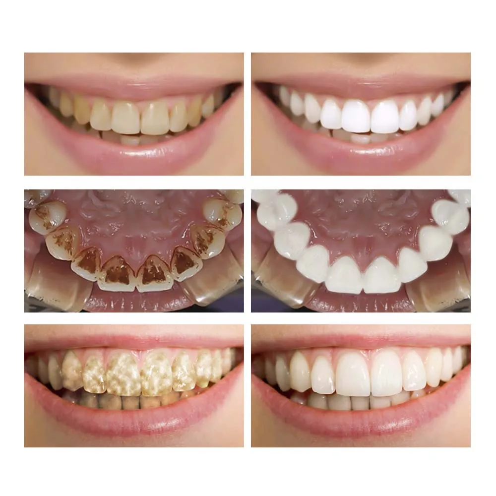 Ламбена отбеливатель для отбеливания зубов эссенция лабена Чистка Белый удаление зубного налета пятна зуб LANBENA идеальная улыбка Стоматологический материал