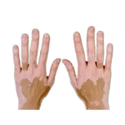 Leukoderma покрывающая ручка водостойкие витилиго корректоры для лица завод жидкий экстракт средства ухода за кожей кожи Скрытая Melanodermia Patches
